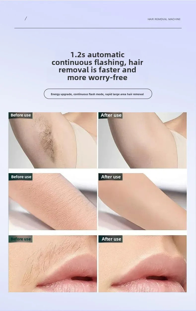 Velluxe IPL Hair Removal Device